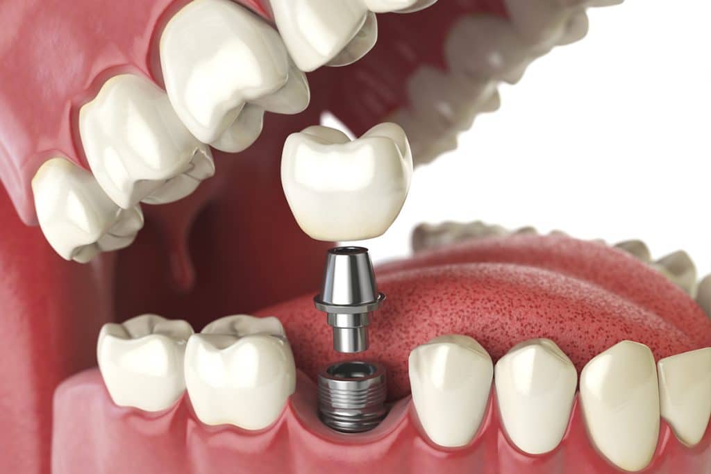 What are Dental Implants Made Of